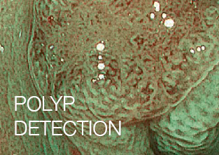 Polyp detection